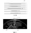 Fig. 06 - Methods and systems for performing a posterior capsulotomy and for laser eye surgery with a penetrated cornea