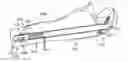 Fig. 01 - Straight intramedullary fracture fixation devices and methods