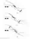 Fig. 83 - Straight intramedullary fracture fixation devices and methods