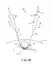 Fig. 04 - Flexible tissue removal devices and methods