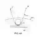 Fig. 09 - Flexible tissue removal devices and methods