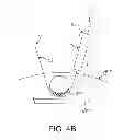 Fig. 10 - Flexible tissue removal devices and methods