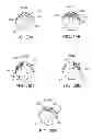 Fig. 22 - Flexible tissue removal devices and methods