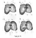 Fig. 03 - SURGICAL GUIDES AND METHODS FOR MANUFACTURING THEREOF