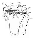 Fig. 01 - High tibial osteotomy guide