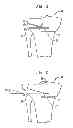 Fig. 02 - High tibial osteotomy guide