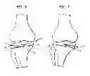 Fig. 05 - High tibial osteotomy guide