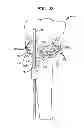 Fig. 09 - High tibial osteotomy guide
