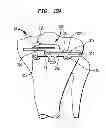 Fig. 16 - High tibial osteotomy guide