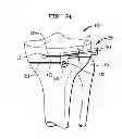 Fig. 22 - High tibial osteotomy guide
