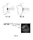 Fig. 07 - Instruments for controlled delivery of injectable materials into bone
