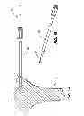 Fig. 03 - SUBCHONDRAL TREATMENT OF BONE DEFECTS WITH BONE-DERIVED IMPLANT