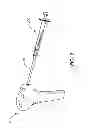 Fig. 04 - SUBCHONDRAL TREATMENT OF BONE DEFECTS WITH BONE-DERIVED IMPLANT