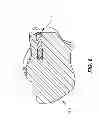 Fig. 07 - SUBCHONDRAL TREATMENT OF BONE DEFECTS WITH BONE-DERIVED IMPLANT