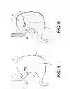 Fig. 05 - Catheter with releasable balloon and related methods