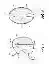 Fig. 06 - Catheter with releasable balloon and related methods