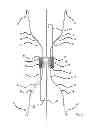 Fig. 03 - Vena cava filter with dual retrieval