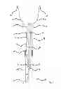 Fig. 04 - Vena cava filter with dual retrieval
