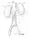 Fig. 02 - Vena cava filter with dual retrieval
