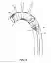 Fig. 07 - CLOT CAPTURE DEVICE