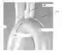 Fig. 01 - EMBOLIC PROTECTION SYSTEM AND METHOD FOR USE IN AN AORTIC ARCH