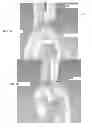 Fig. 07 - EMBOLIC PROTECTION SYSTEM AND METHOD FOR USE IN AN AORTIC ARCH