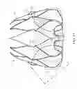 Fig. 02 - Fixation Anchor Design for an Occlusion Device