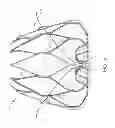 Fig. 06 - Fixation Anchor Design for an Occlusion Device