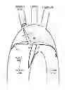 Fig. 01 - DEVICE AND METHOD FOR DEFLECTING EMBOLI IN AN AORTA