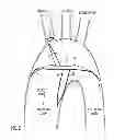 Fig. 04 - DEVICE AND METHOD FOR DEFLECTING EMBOLI IN AN AORTA