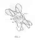 Fig. 04 - Percutaneous atrial and ventricular septal defect closure device