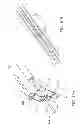 Fig. 16 - Percutaneous atrial and ventricular septal defect closure device