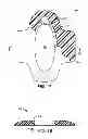 Fig. 02 - BIOPSY INCISION CLOSURE DEVICE