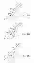 Fig. 17 - WOUND CLOSURE DEVICES AND METHODS OF USE