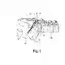 Fig. 06 - Implant for pelvic ring fractures