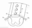 Fig. 01 - Coupled monopolar and multipolar pulsing for conditioning and stimulation
