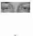Fig. 06 - Eye aperture enhancing prosthesis and method