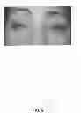 Fig. 07 - Eye aperture enhancing prosthesis and method