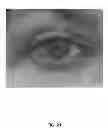 Fig. 22 - Eye aperture enhancing prosthesis and method