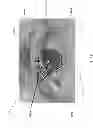 Fig. 43 - Eye aperture enhancing prosthesis and method