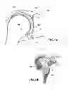 Fig. 02 - Shoulder implant