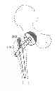 Fig. 01 - Method and apparatus for hip replacement