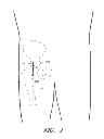 Fig. 02 - Method and apparatus for hip replacement