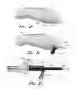 Fig. 45 - Method and apparatus for hip replacement