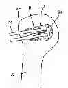 Fig. 01 - Expandable implant