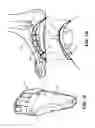 Fig. 06 - Sole structures and articles of footwear having plate moderated fluid-filled bladders and/or foam type impact force attenuation members