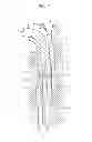 Fig. 10 - Laryngeal mask