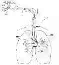 Fig. 01 - Medical tubes for selective mechanical ventilation of the lungs
