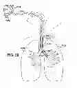Fig. 11 - Medical tubes for selective mechanical ventilation of the lungs
