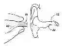 Fig. 01 - EAR INSERT FOR RELIEF OF TMJ DISCOMFORT AND HEADACHES